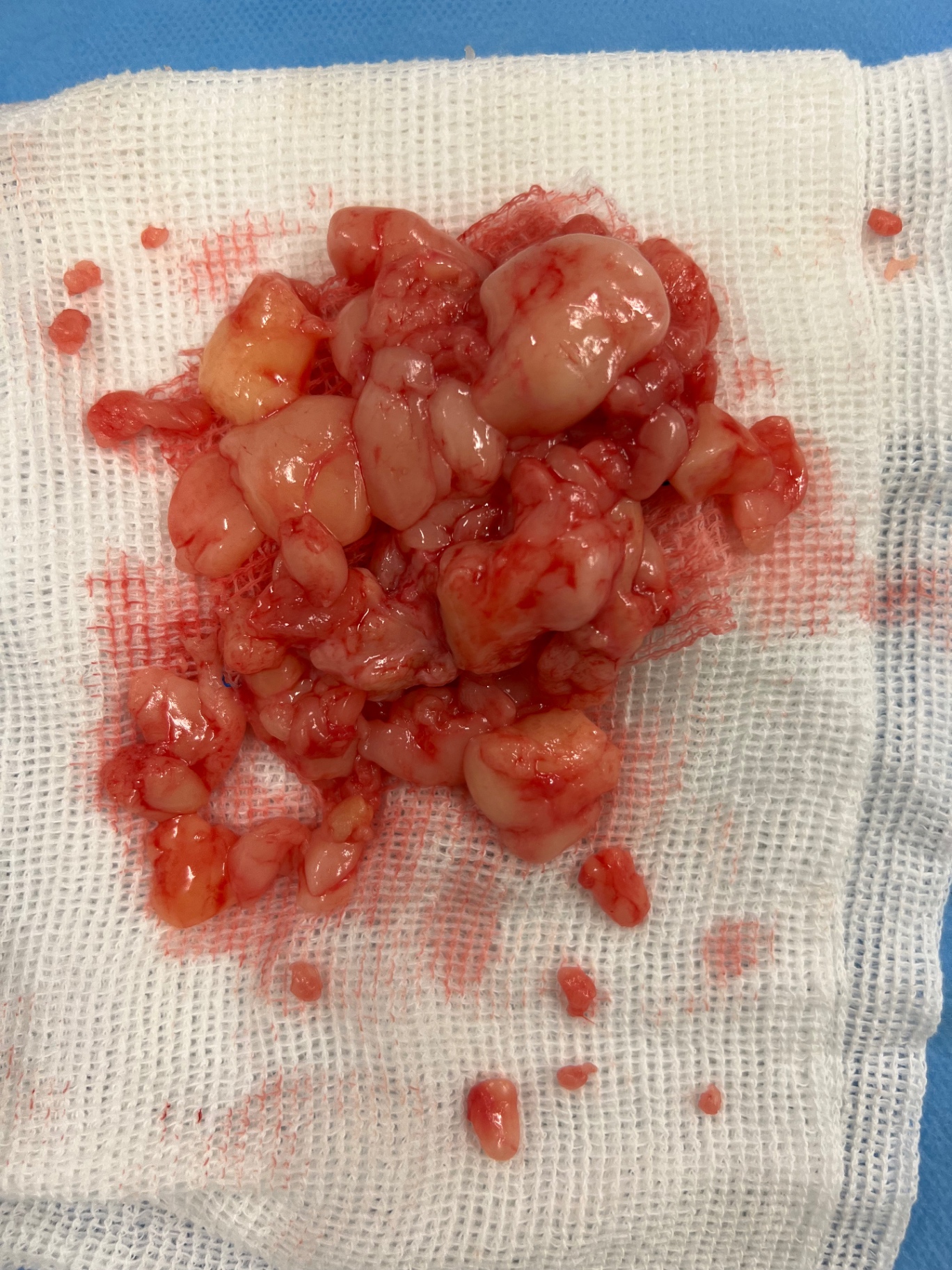 Nódulos de lipedema removidos cirurgicamente — fragmentos lobulados esbranquiçados sobre compressa