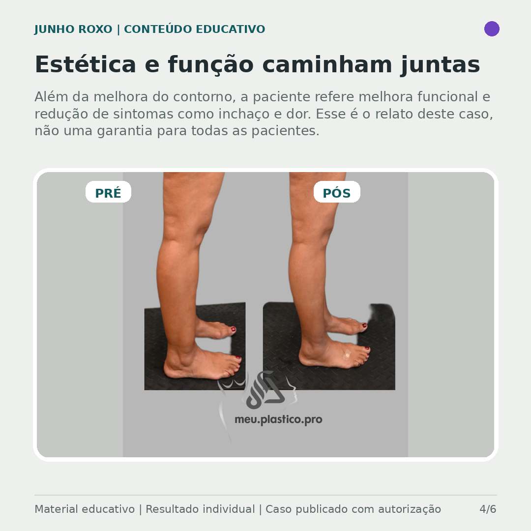 Comparativo lateral pré e pós lipoaspiração de lipedema — vista de perfil