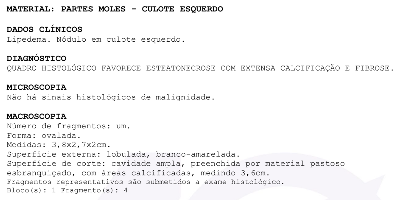 Laudo anatomopatológico de nódulo de lipedema em culote esquerdo: esteatonecrose com extensa calcificação e fibrose, sem sinais de malignidade
