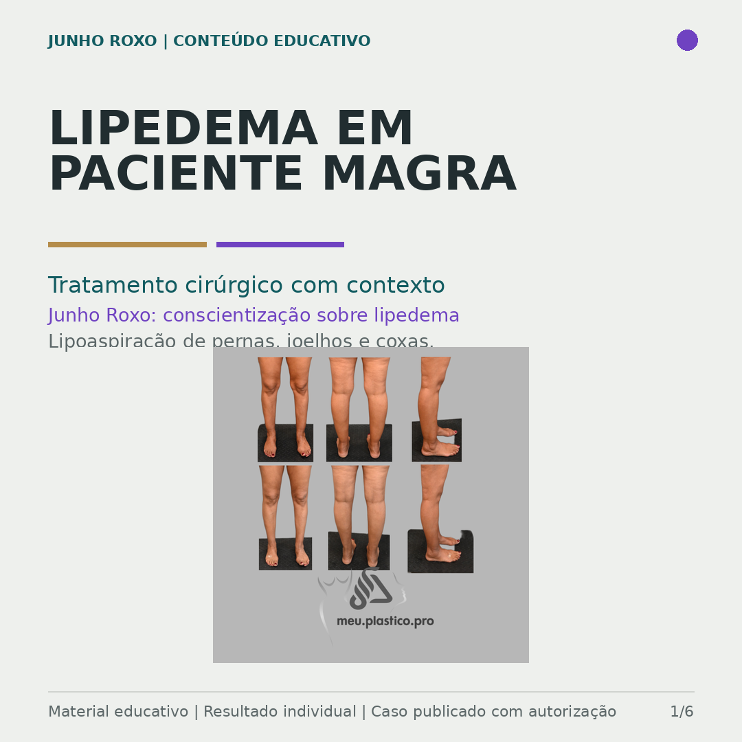 Montagem de 6 vistas pré-operatórias do lipedema — frontal, posterior e lateral, em paciente magra