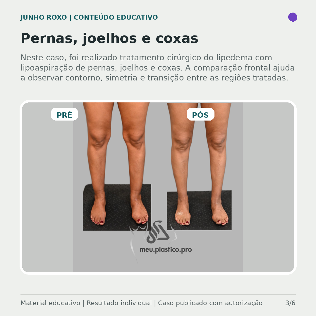 Comparativo frontal pré e pós tratamento cirúrgico do lipedema com lipoaspiração de pernas, joelhos e coxas