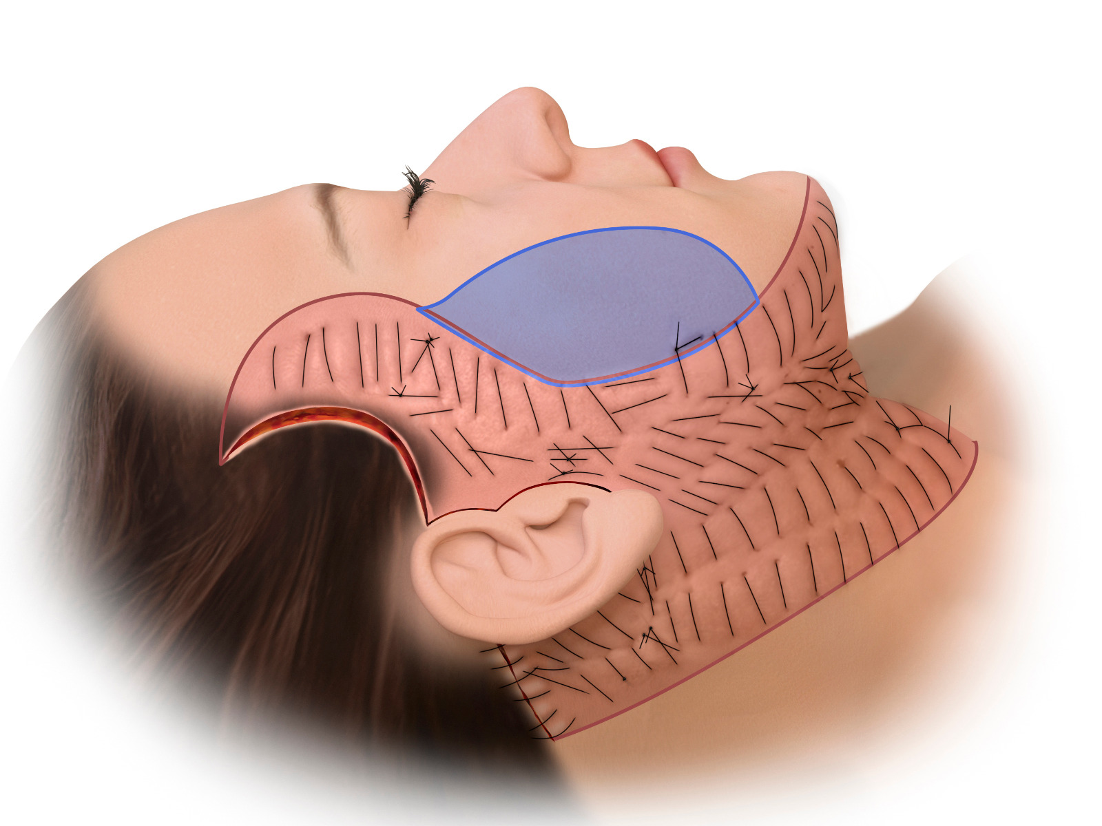 Ilustração de rede hemostática em cirurgia de face e pescoço: pontos seriados sobre a área descolada, com retalho retroauricular evidenciado