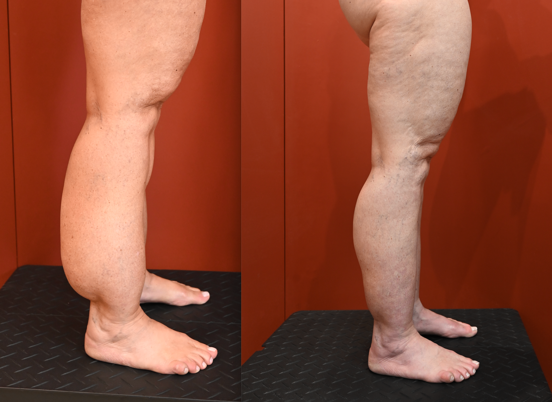 Pré e pós-operatório de cirurgia de lipedema — comparativo lado a lado das pernas