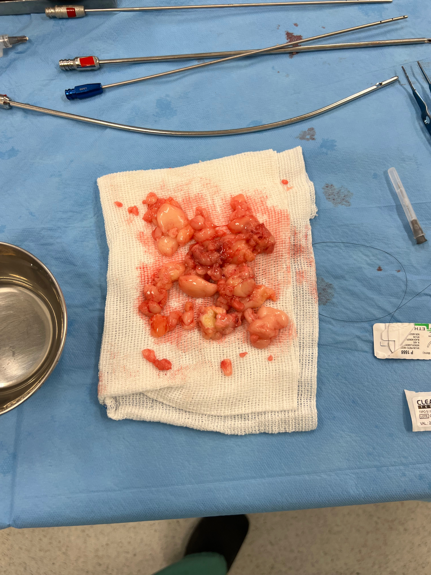 Material cirúrgico ao lado dos nódulos de lipedema removidos