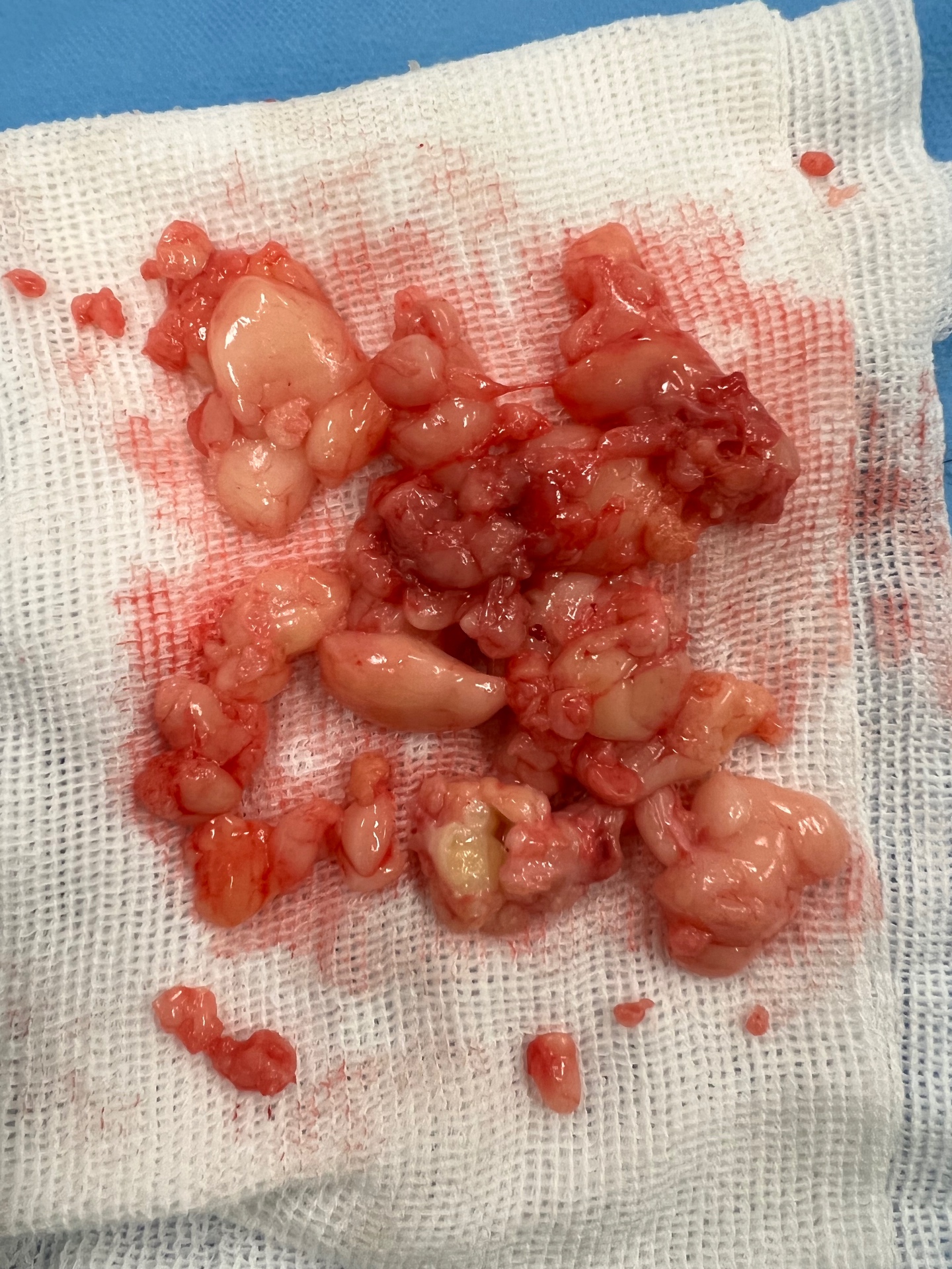 Detalhe dos nódulos de lipedema mostrando aspecto lobulado e áreas de necrose gordurosa