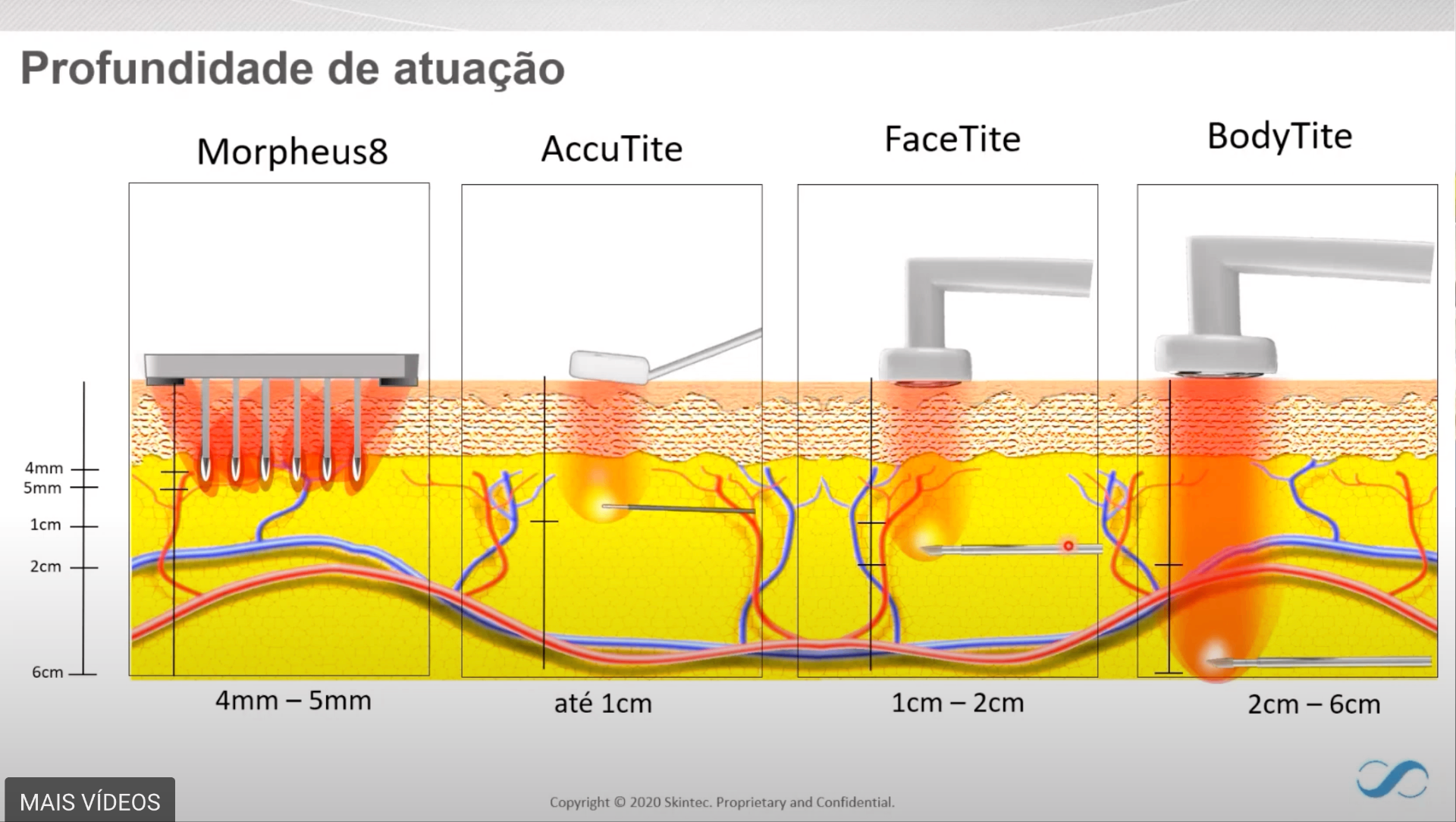 Comparativo de profundidade de atuação: Morpheus8 (4–5mm), AccuTite (até 1cm), FaceTite (1–2cm) e BodyTite (2–6cm)