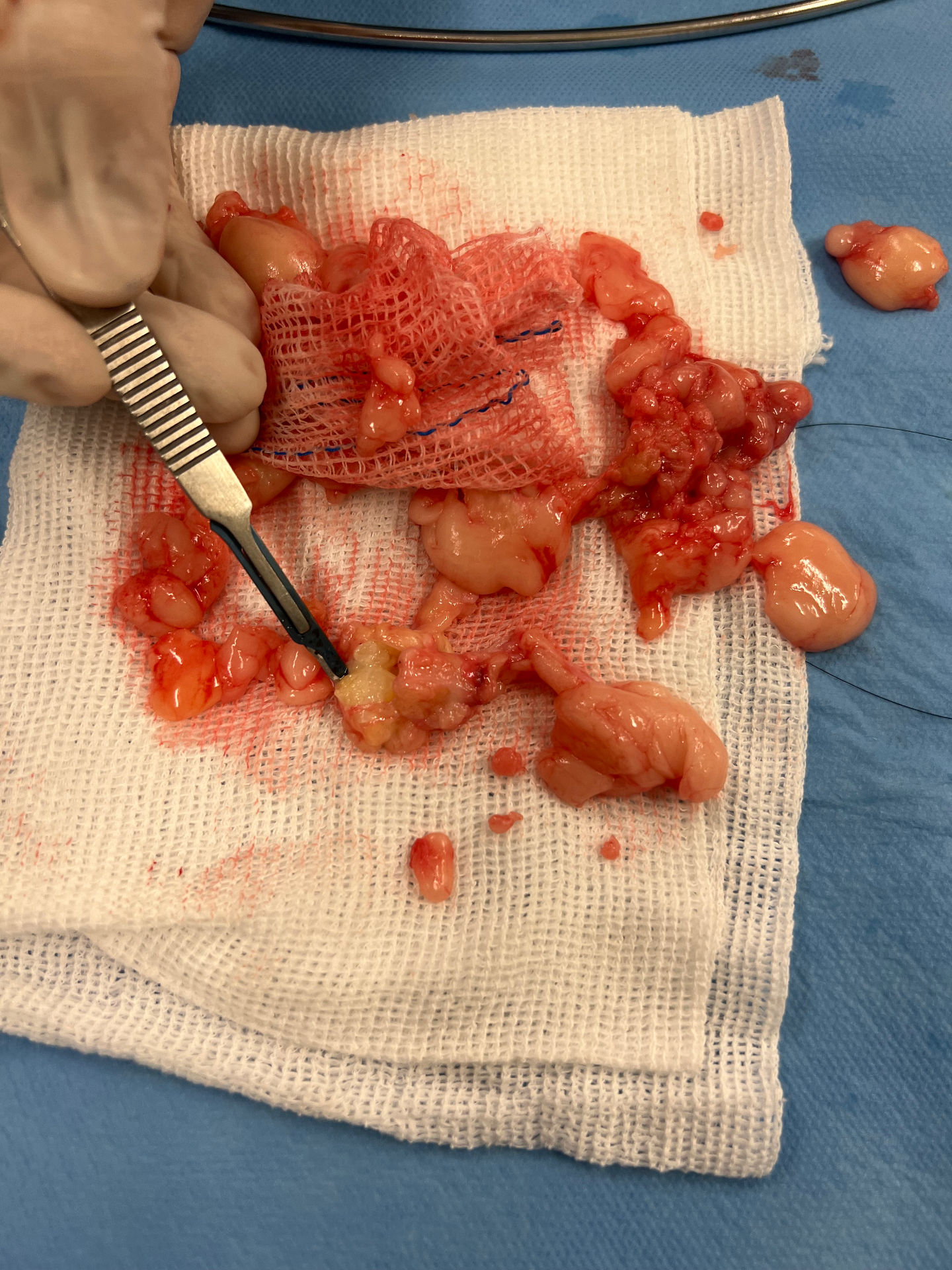 Cirurgião manipulando nódulo de lipedema com pinça anatômica para inspeção