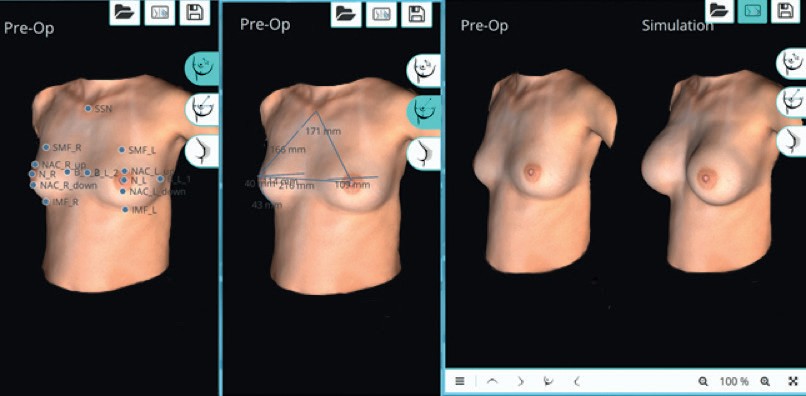 Referências anatômicas, medidas e simulação 3D do implante mamário