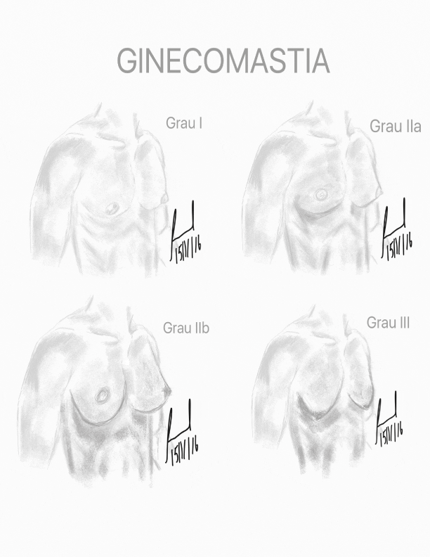 Classificação ginecomastia