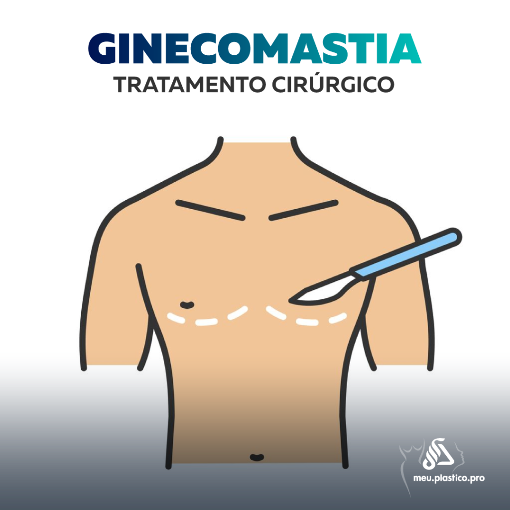 tratamento ginecomastia