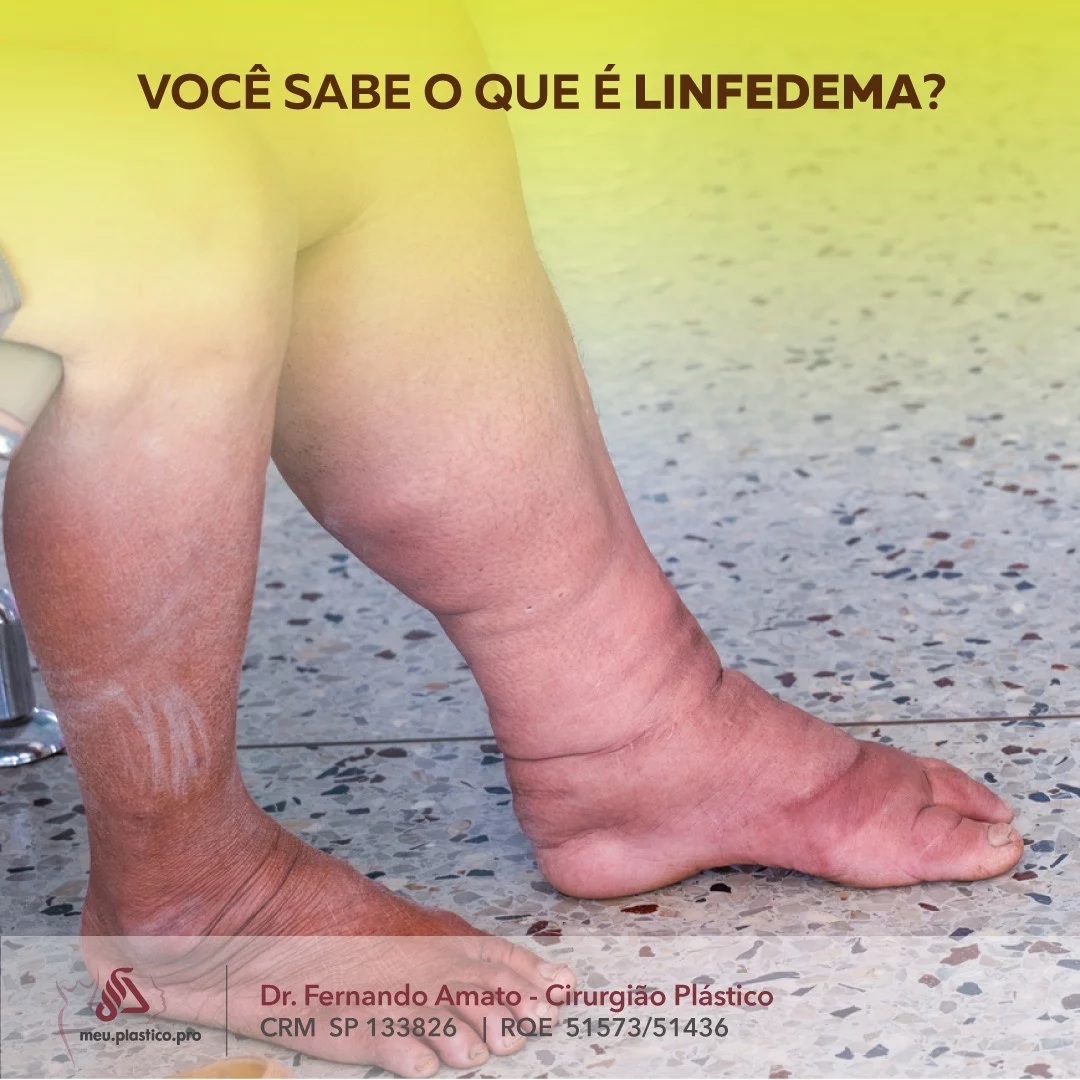 Lipedema atinge 10% das brasileiras e é confundida com inchaço