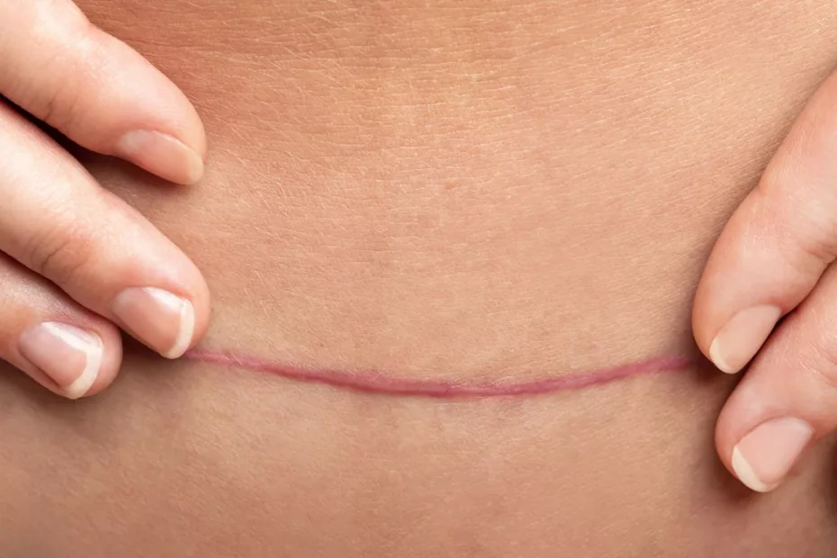 mulher mostrando uma Cicatriz Hipertrófica no abdome