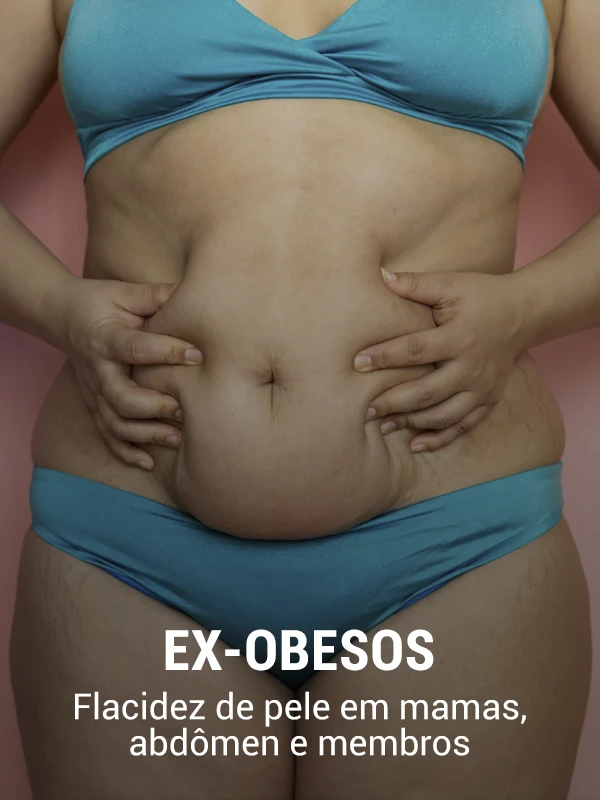 Ex-obesos