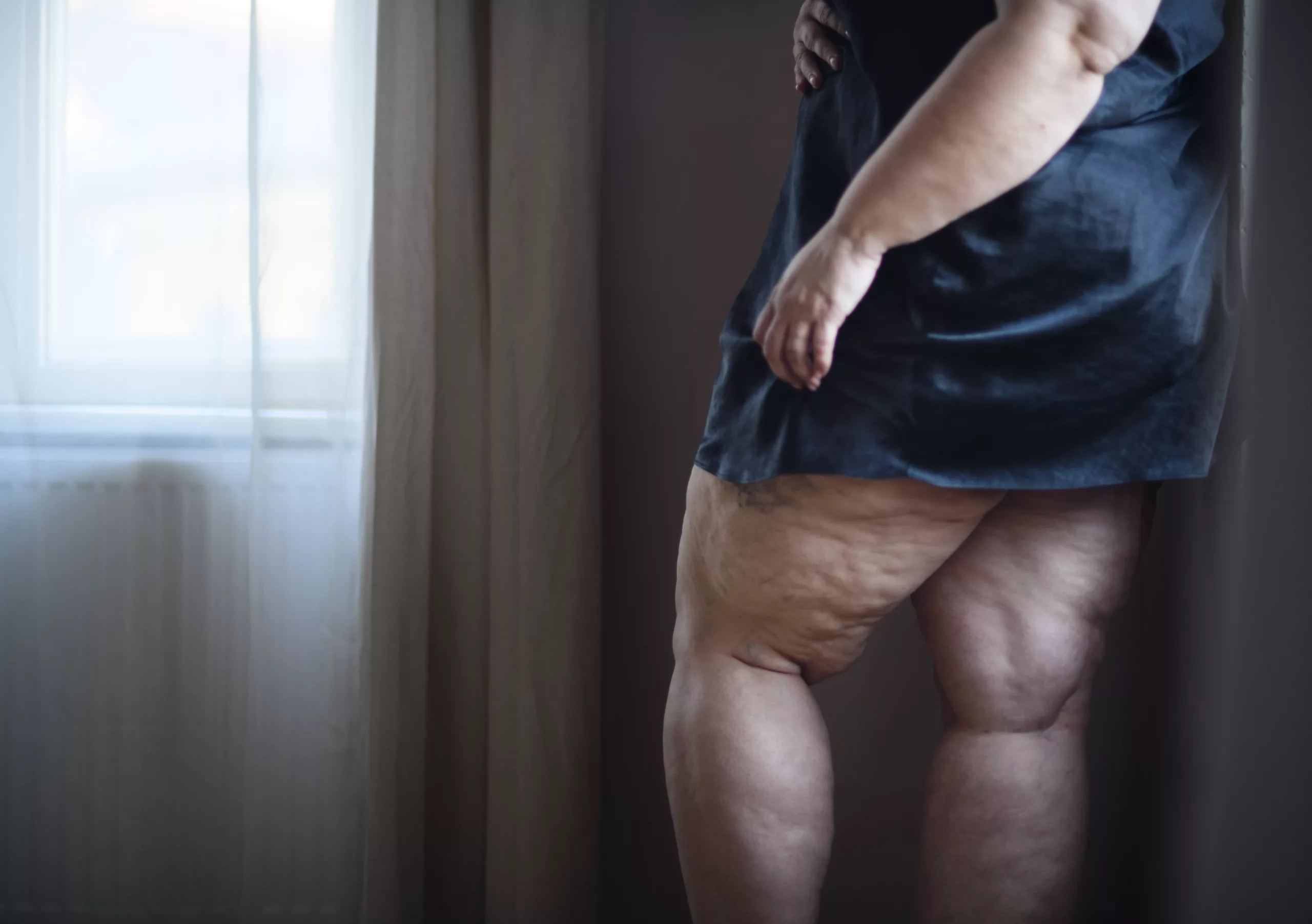 https://plastico.pro/wp-content/uploads/2023/05/fat-woman-with-cellulite-on-her-legs-cut-out-2022-04-12-20-14-20-utc-scaled.webp