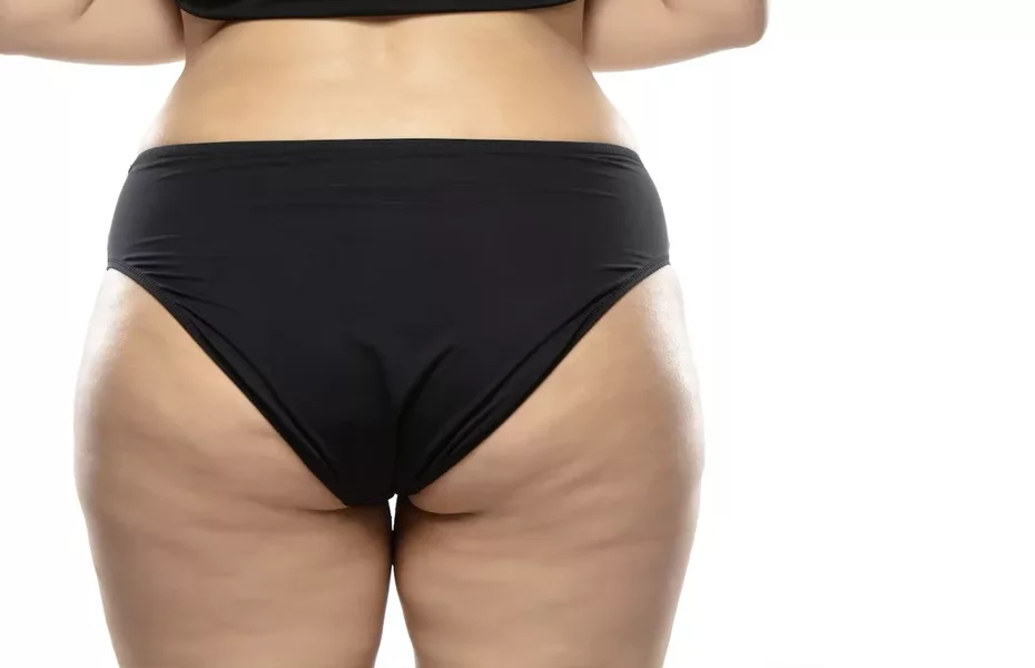 A visão posterior de uma mulher em um biquíni preto com a pele do bumbum flácida. Pele flácida