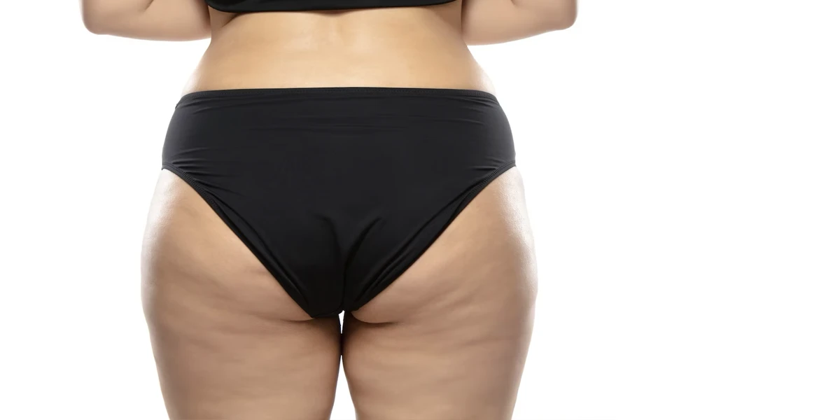 A visão posterior de uma mulher em um biquíni preto com a pele do bumbum flácida. Pele flácida