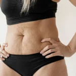 Imagem mostrando o abdomem de uma mulher antes de realizar o procedimento da abdominoplastia