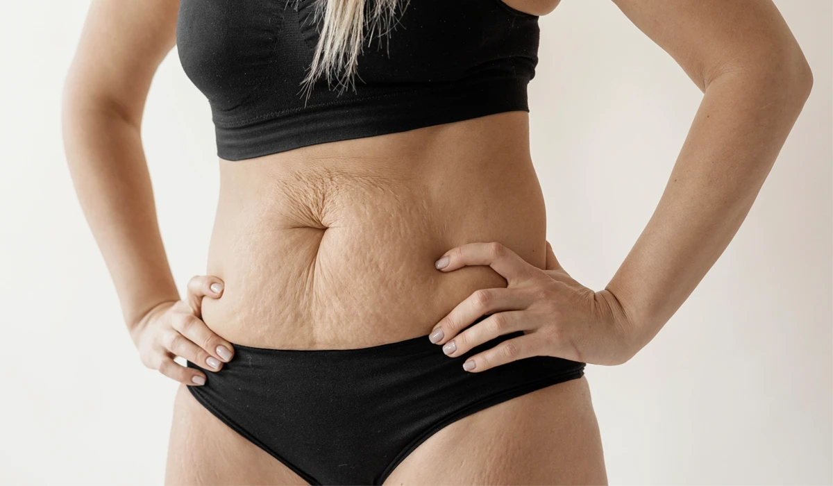 Imagem mostrando o abdomem de uma mulher antes de realizar o procedimento da abdominoplastia